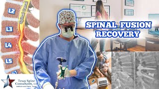 Spinal Fusion Recovery EXPECTATIONS 🧗‍♀️🏨🏌️🏆 [upl. by Enia]