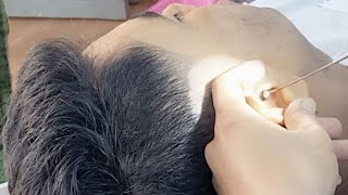 Earwax remove ASMR in Cambodia 2022 [upl. by Adnuhser347]