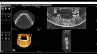 CS 3D Imaging Mapping Mandibular Nerves [upl. by Akimat]