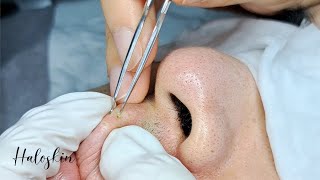 Satisfying Relaxing Removing All Seed of Acne Acne and Blackheads 黑頭粉刺 Shorts [upl. by Arihsaj]