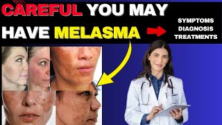 YOU COULD HAVE MELASMA AND NOT EVEN KNOW IT – SPOT THE SIGNS BEFORE IT’S TOO LATE [upl. by Namzed]