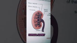 Normal kidney vs Glomerulonephritis medical biology kidney shorts gk yt shorts [upl. by Janeva]