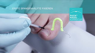 Entlastung für eingewachsene Nägel  RUCK® NAGELKORREKTUR  ORTOGRIP professional [upl. by Weinberg]