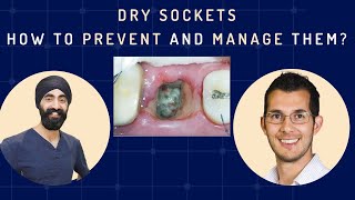 Dry Sockets  How to Prevent and Manage Them Oral Surgery Complications  GF010 [upl. by Morel319]