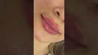 New lips Treatment Lips Filler Purpose Non surgical aesthetics [upl. by Betta]