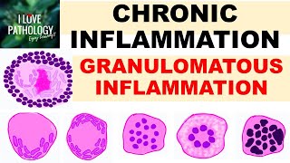 INFLAMMATION Part 9 Chronic Inflammation  GRANULOMATOUS INFLAMMATION [upl. by Attelliw]