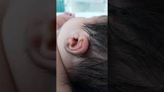 Case 266 neonatal hypertrichosis with infant of diabetic mother congenital hypothyroidism hairy [upl. by Heiney]