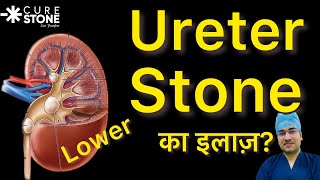 Lower Ureteral Stones Treatmentlaser RIRS kidneystone Dr Deepanshu Gupta Urologist Hydronephrosis [upl. by Coopersmith817]