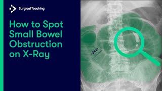 How to Spot Small Bowel Obstruction on XRay [upl. by Amsirp]