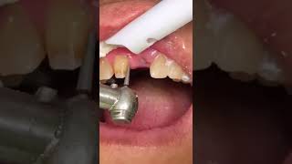 Porcelain Crown and Bridge To Replacing Missing Tooth  In Office To Hands On Dental Training [upl. by Deegan]