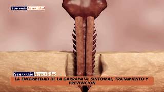 La enfermedad de la garrapata Síntomas tratamiento y prevención [upl. by Ydnir]