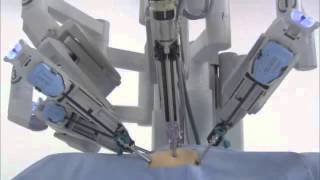 da Vinci® Surgery  How It Works [upl. by Anha]