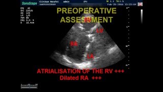 EBSTEIN ANOMALY ANESTHESIA FOR NONCARDIAC SURGERY IN ADULT PATIENT WITH EBSTEIN ANOMALY [upl. by Lhadnek816]