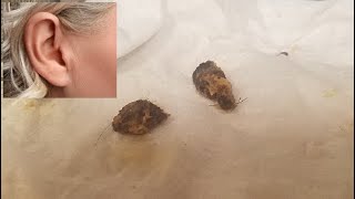 Does EARWAX Alone Cause Temporary Complete HEARING Loss Ear Wax Removal Cant Hear Crackling Cerumen [upl. by Augustine]