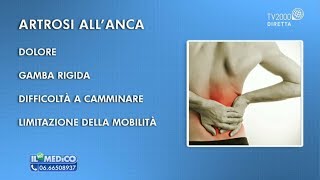 Il Mio Medico  Artrosi allanca come si riconosce [upl. by Miranda286]