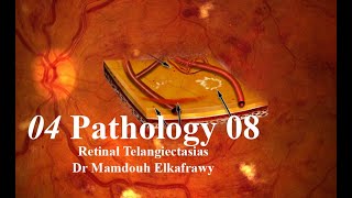 04 Retinal Pathology 08 Elkafrawy pathology باثولوجيالكفراوي Idiopathic telangiectasia ampLebers [upl. by Sapers]