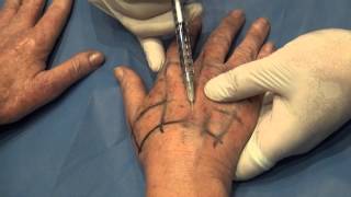 Hands Rejuvenation and Hands Lift by Endopeel Technics [upl. by Itsim529]