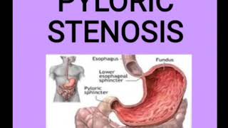 Pyloric stenosis [upl. by Schreibe]