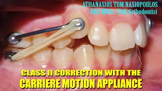 Class II correction with Carriere  Athanasios Tom Nasiopoulos [upl. by Scarlett]