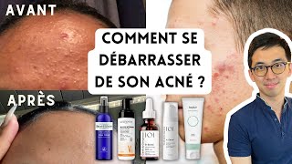 PEAU SANS ACNÉ  BOUTONS BLANCS OU ROUGES MICROKYSTES PLAQUES DE BOUTONS PAPULES PUSTULES [upl. by Chill]