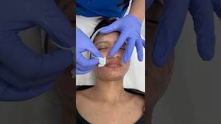 Second chemical peel session done acnetreatment chemicalpeel mandalicpeel chemicalpeeltreatment [upl. by Ribal803]