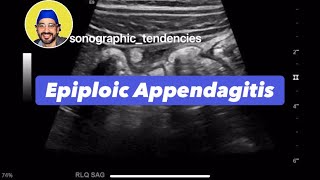 Epiploic Appendagitis [upl. by Aisirtap993]