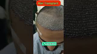 5000 grafts front hair transplant full density 9915696128 [upl. by Karisa]