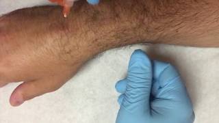 Wrist pain tendinopathy Trigger point injection [upl. by Aienahs]