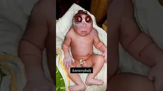 Anencephaly youtubeshorts viral newborn paediatrics birth medical trending doctor obgyn kb [upl. by Kruger953]