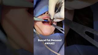 Buccal fat pad removal real surgical footage AWAKE in office Dr Kirk Lozada [upl. by Baalman]