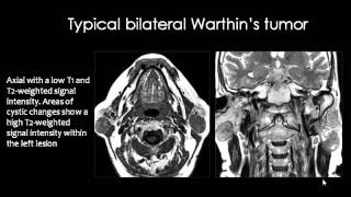 Radiology  Salivary Glands Imaging  Head and Neck [upl. by Rehotsirhc]