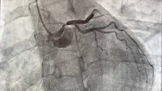 Angiography of the Left Main Coronary Artery [upl. by Spatola]