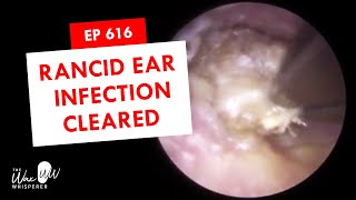 616  Rancid Ear Infection Cleared [upl. by Atilemrac]