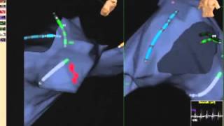 Electrophysiological Study amp Catheter Ablation [upl. by Noelyn414]