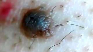 Back Blackhead Extraction Session 2 in quotMrs GoldquotAddressing the Inflamed One [upl. by Egedan779]