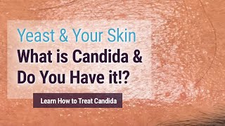 Yeast affecting your skin You may have it and not know Candida Albicans [upl. by Crissie]