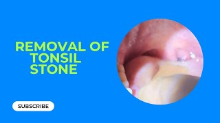 Removal of Tonsil stone  টনসিল স্টোন অপসারণटॉन्सिल स्टोन का इलाज [upl. by Alastair]