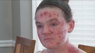 Georgia woman battles pain after using steroid cream [upl. by Nuawad]