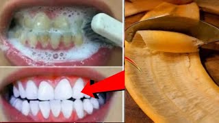 In Just 2minutes Whiten Yellow stained Teeth at Home BEST TEETH WHITENING REMEDY ll NGWorld [upl. by Valenta]