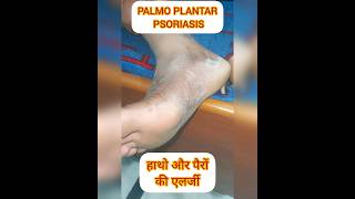 PALMOPLANTAR PSORIASIS psoriasis itching dryskin shortsfeed shortvideo shorts ytviral SHORT [upl. by Dhaf]