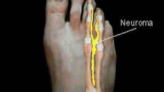 Excision of Mortons Neuroma  Surgical Animation [upl. by Enylrac626]