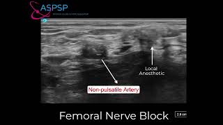 Femoral Nerve Block in an Amputee [upl. by Hiett]