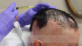 Successfully Treating Alopecia Areata with PRP Treatment [upl. by Eustace268]