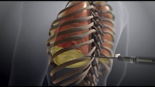 Thoracentesis [upl. by Geaghan]