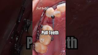 How to pull teeth when braces braces orthodontist dentist dental [upl. by Hacker]