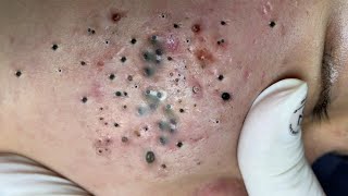 Big Cystic Acne Blackheads Extraction Blackheads amp Milia Whiteheads Removal Pimple Popping  6771 [upl. by Aynam]