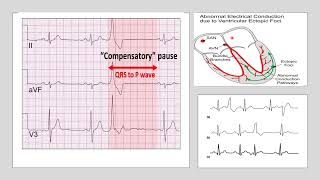 Compensatory pause occurs after Extrasystole by Prof Dr Sanhita Mukherjee [upl. by Veronika]