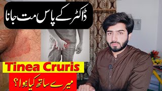 Private Part itching  Tinea Cruris  Fungle Infection  Babar Ali Hashmi [upl. by Amando92]