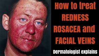 How to treat rosacea redness amp facial veins [upl. by Bolitho]