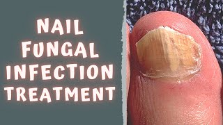 HOW TO TREAT FUNGAL NAIL INFECTION  TINEA UNGUIUM  ONYCHOMYCOSIS [upl. by Anika]